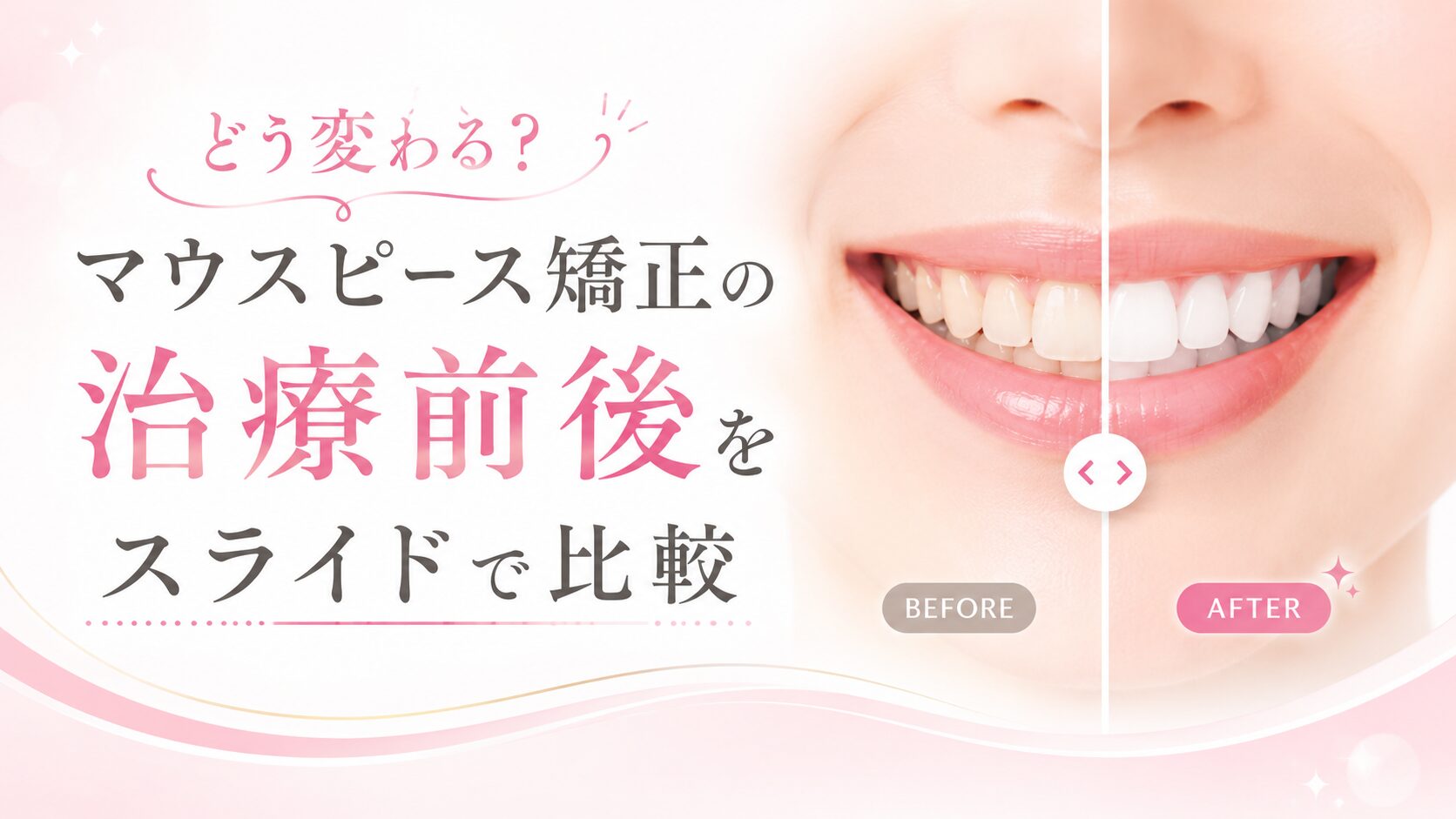 どう変わる？マウスピース矯正の治療前後をスライドで比較